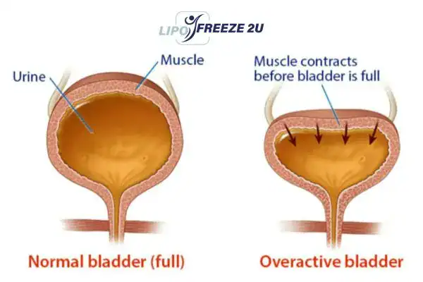 diagram of overactive bladder treatment Coombe Bissett