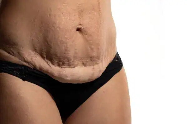 loose skin after weight loss injections Coombe Bissett