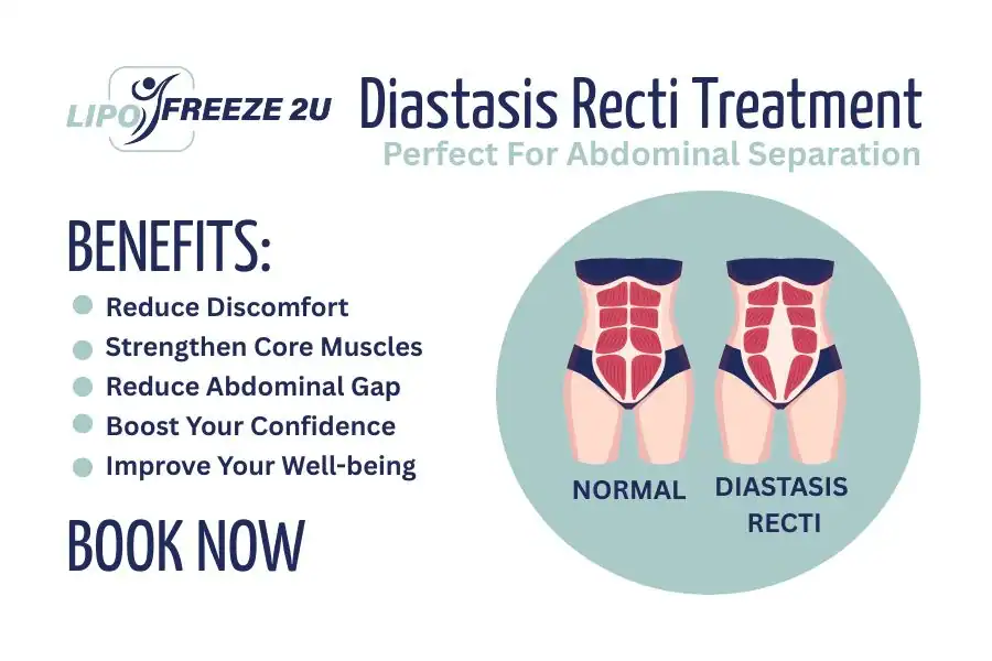 How Long Will It Take to See Improvements in Diastasis Recti Coombe Bissett