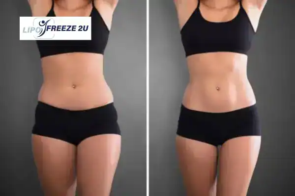 How Can LIPO FREEZE 2U Support Your Post-Pregnancy Body Recovery Coombe Bissett?
