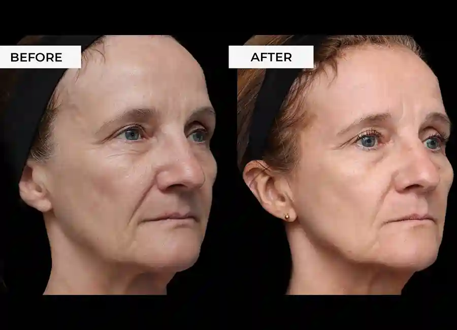 How Many RF Microneedling Sessions Will You Need to See a Difference Coombe Bissett?