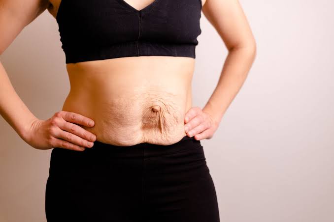 Is Surgery Really the Only Way to Repair Diastasis Recti Coombe Bissett?
