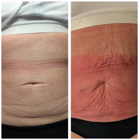 How Does RF Microneedling Improve Crepey, Thin and Uneven Skin Texture Coombe Bissett?