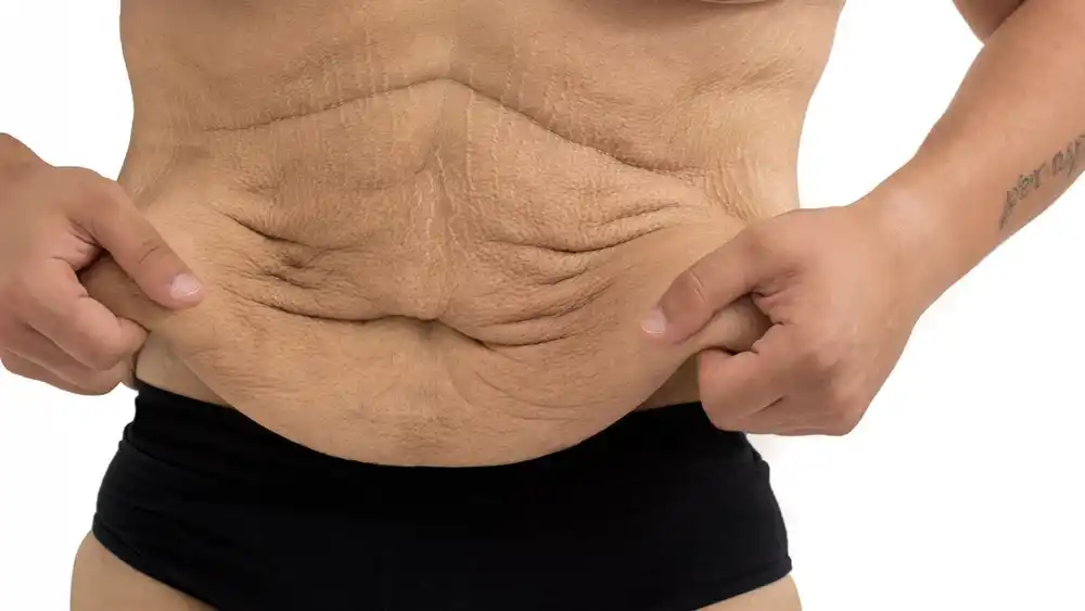 RF Microneedling for Loose Skin: How Can It Help Tighten and Reshape the Skin Coombe Bissett?